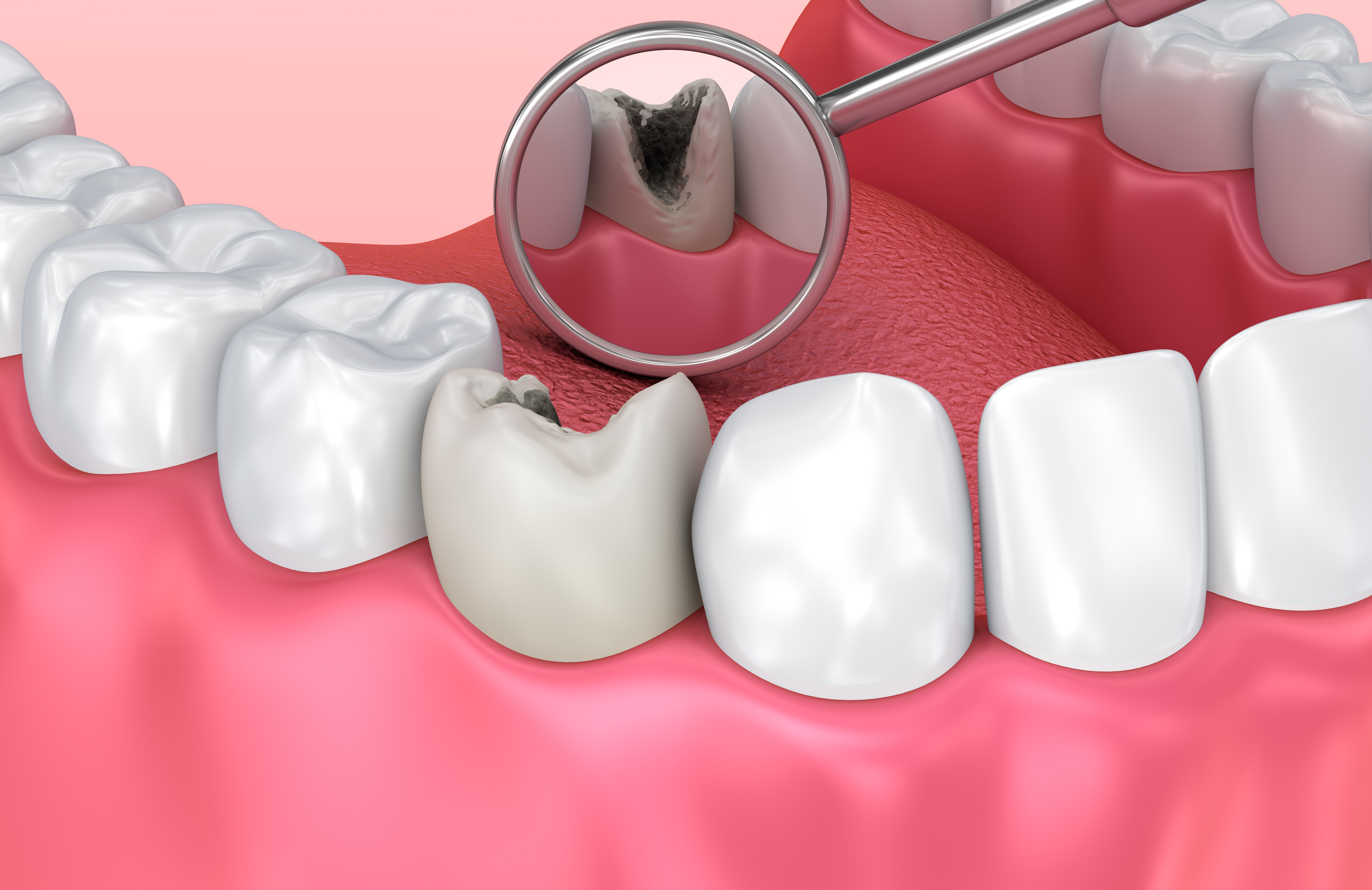 digital illustration of a dental mirror reflecting a large caries requiring a cavity filling.