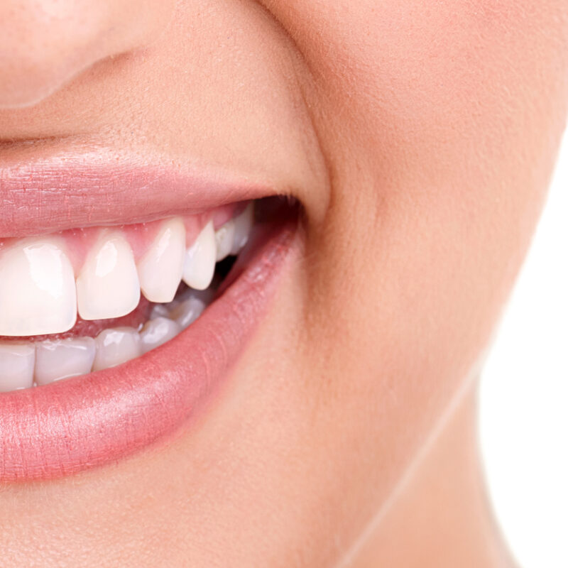 close up of woman's smile with and without braces from an orthodontist