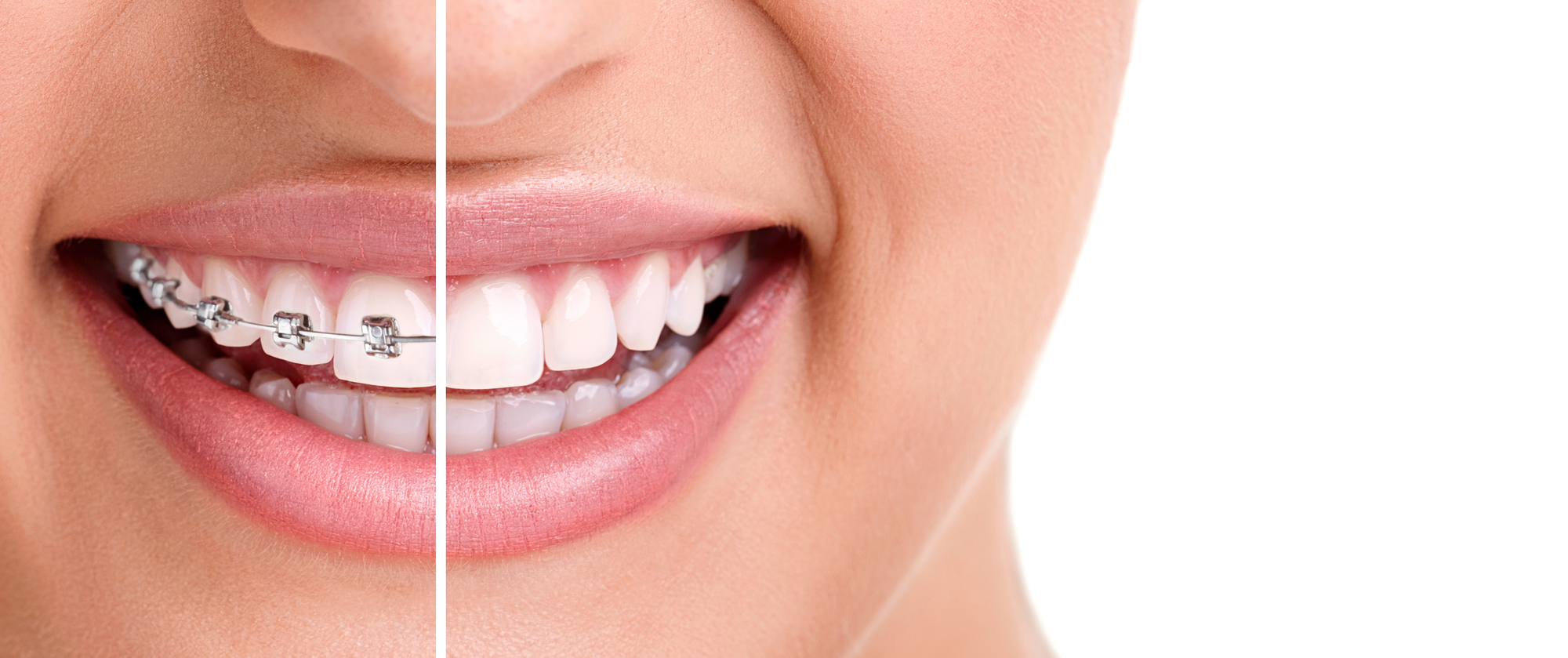 Orthodontist vs Dentist: Who should I see for braces? 
