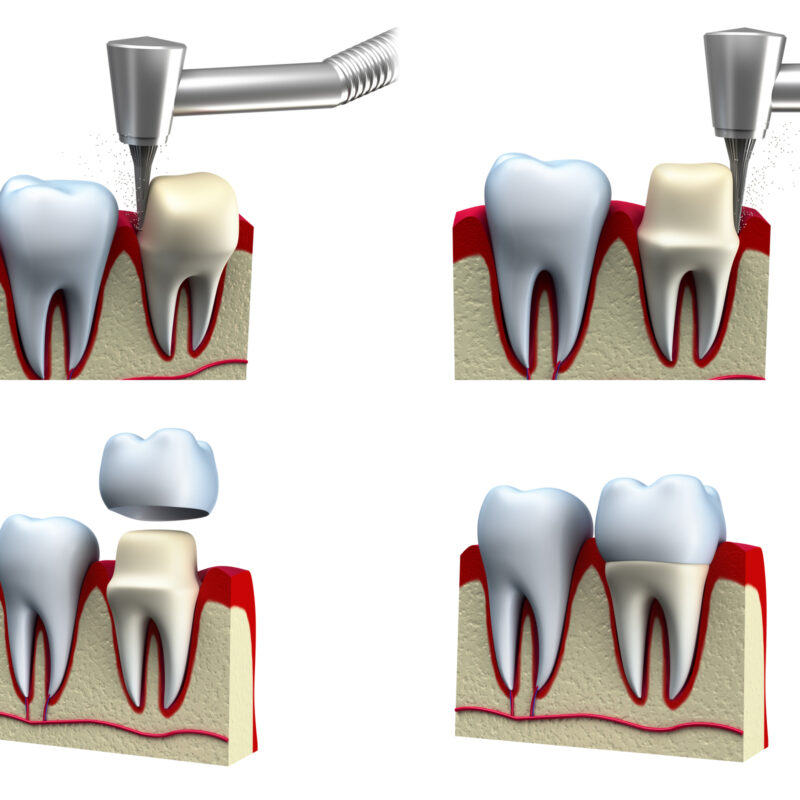 four images showing the process of placing a dental crown over a damaged tooth