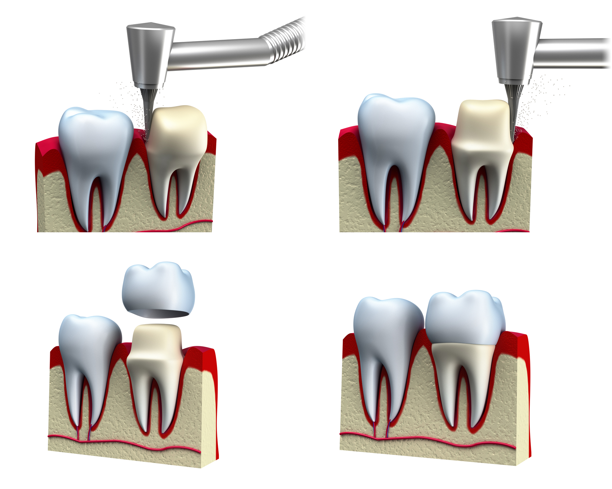 6 Ways to Improve Your Smile With Dental Crowns