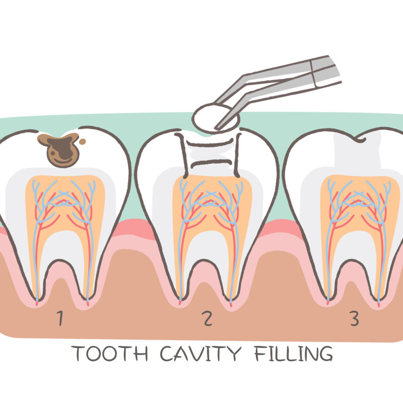 tooth cavity filling on the white background