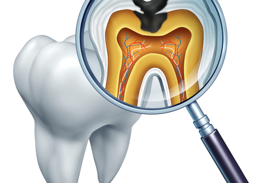 Tooth cavity close up and cavities symbol showing a magnifying glass with a cross section of a tooth anatomy in decay due to bacteria and acids in oral health care showing rotting and disease due to lack of brushing.