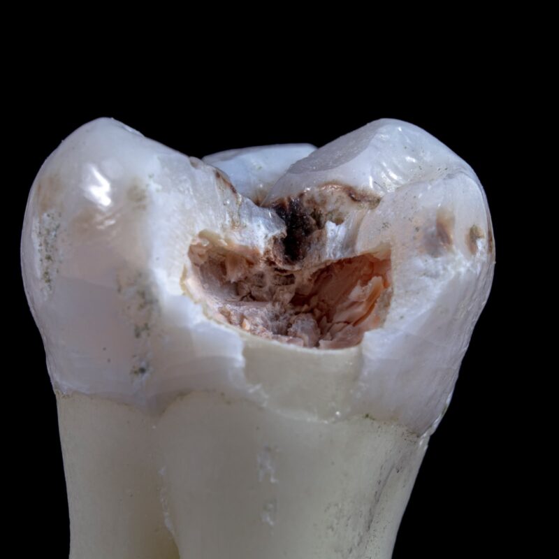 close up of tooth with a cavity on black background