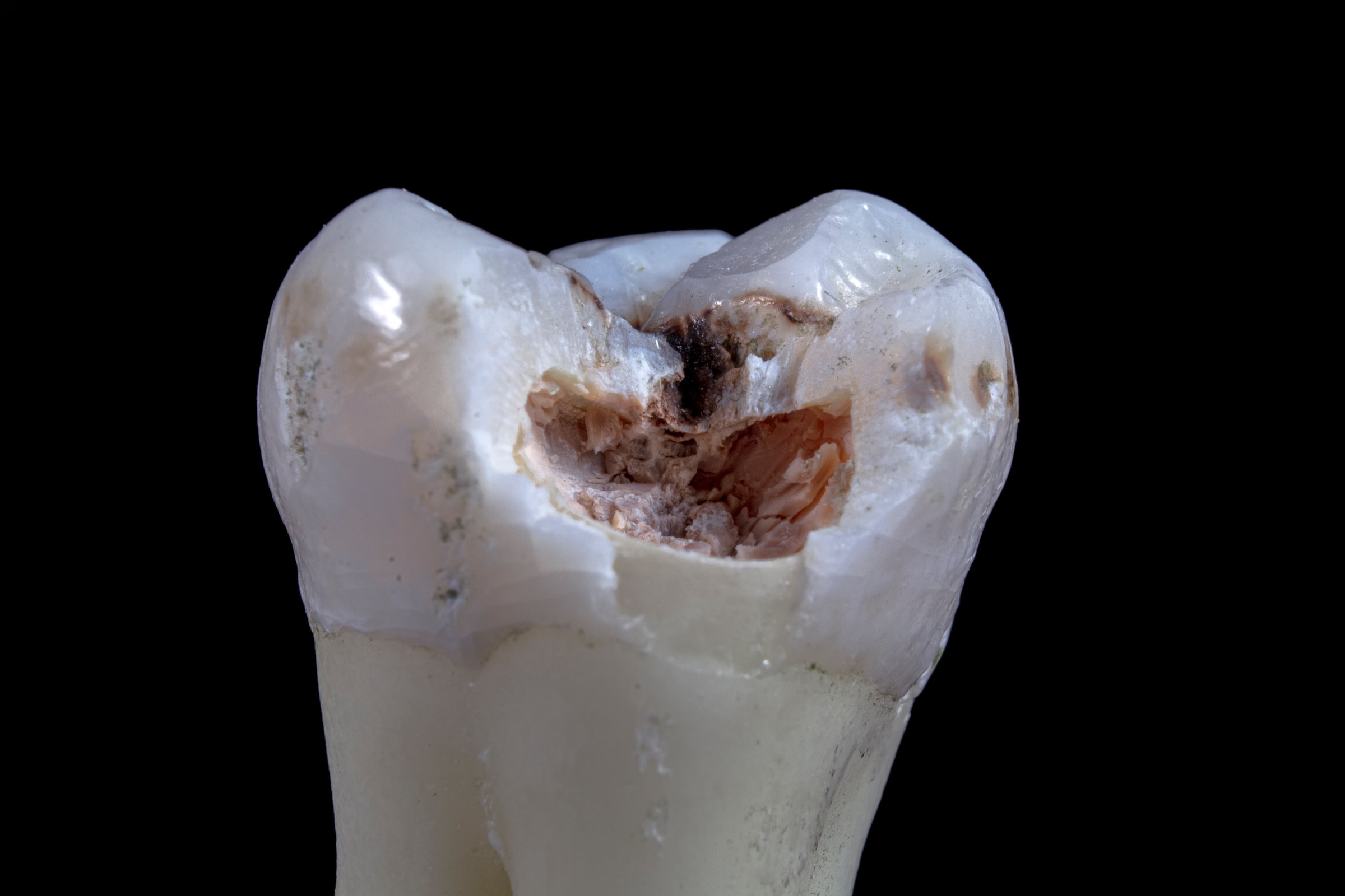 Need a Cavity Filling? Don’t Believe These 5 Misconceptions!