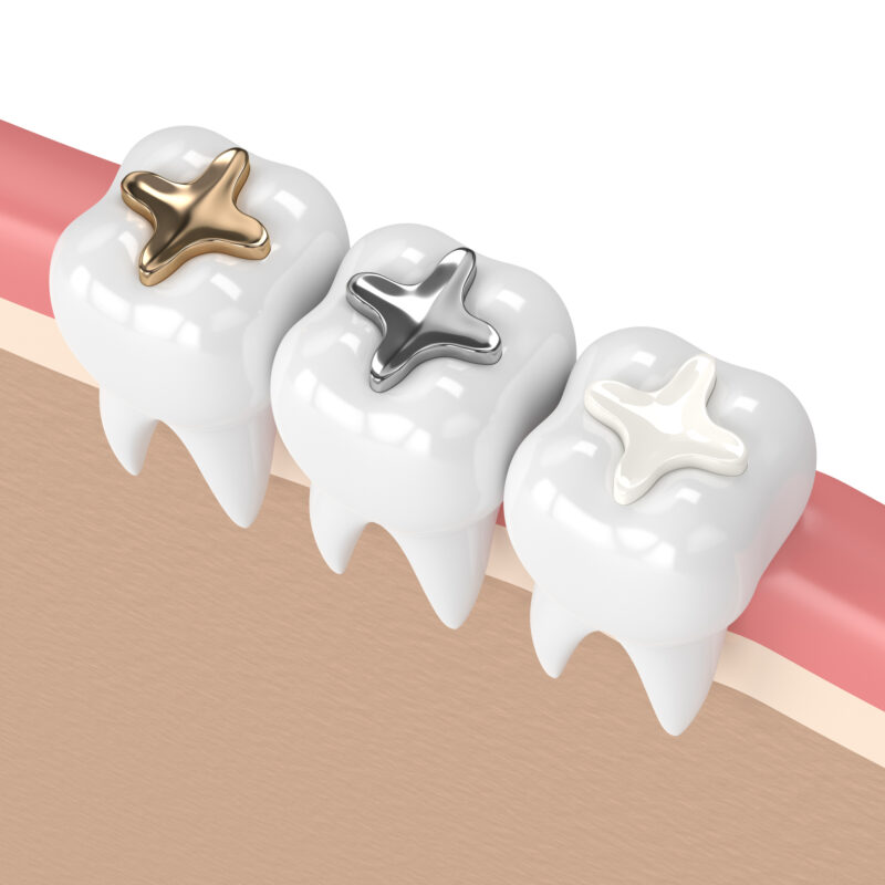 3D render of gold, silver, and white cavity fillings