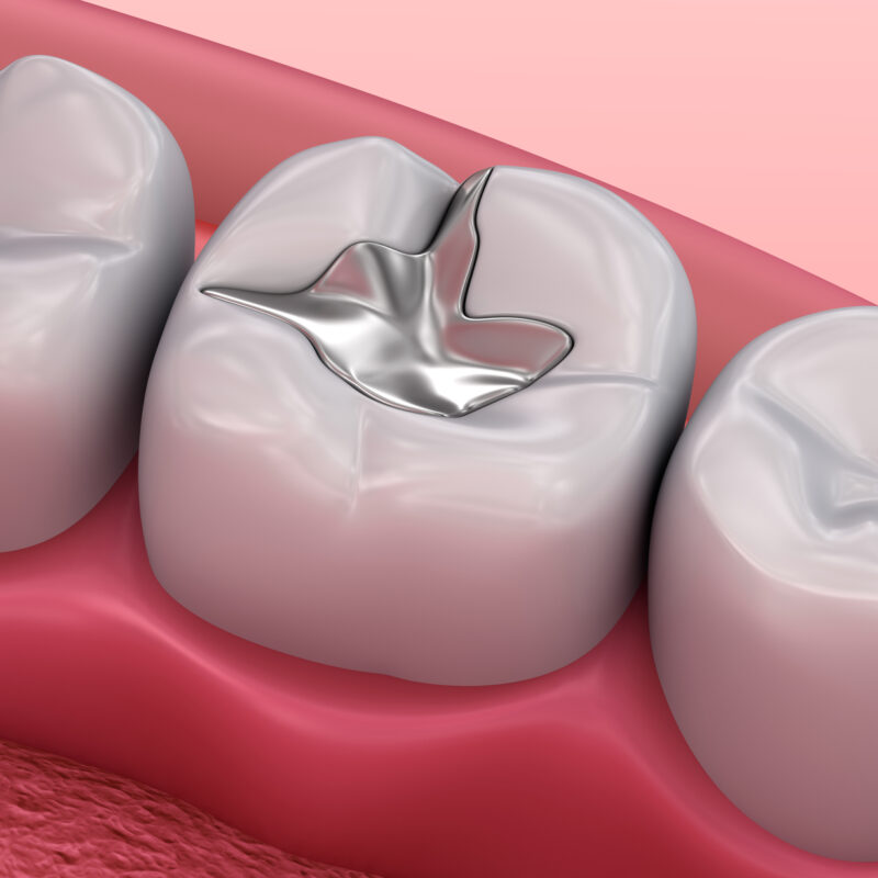 metal fillings in teeth