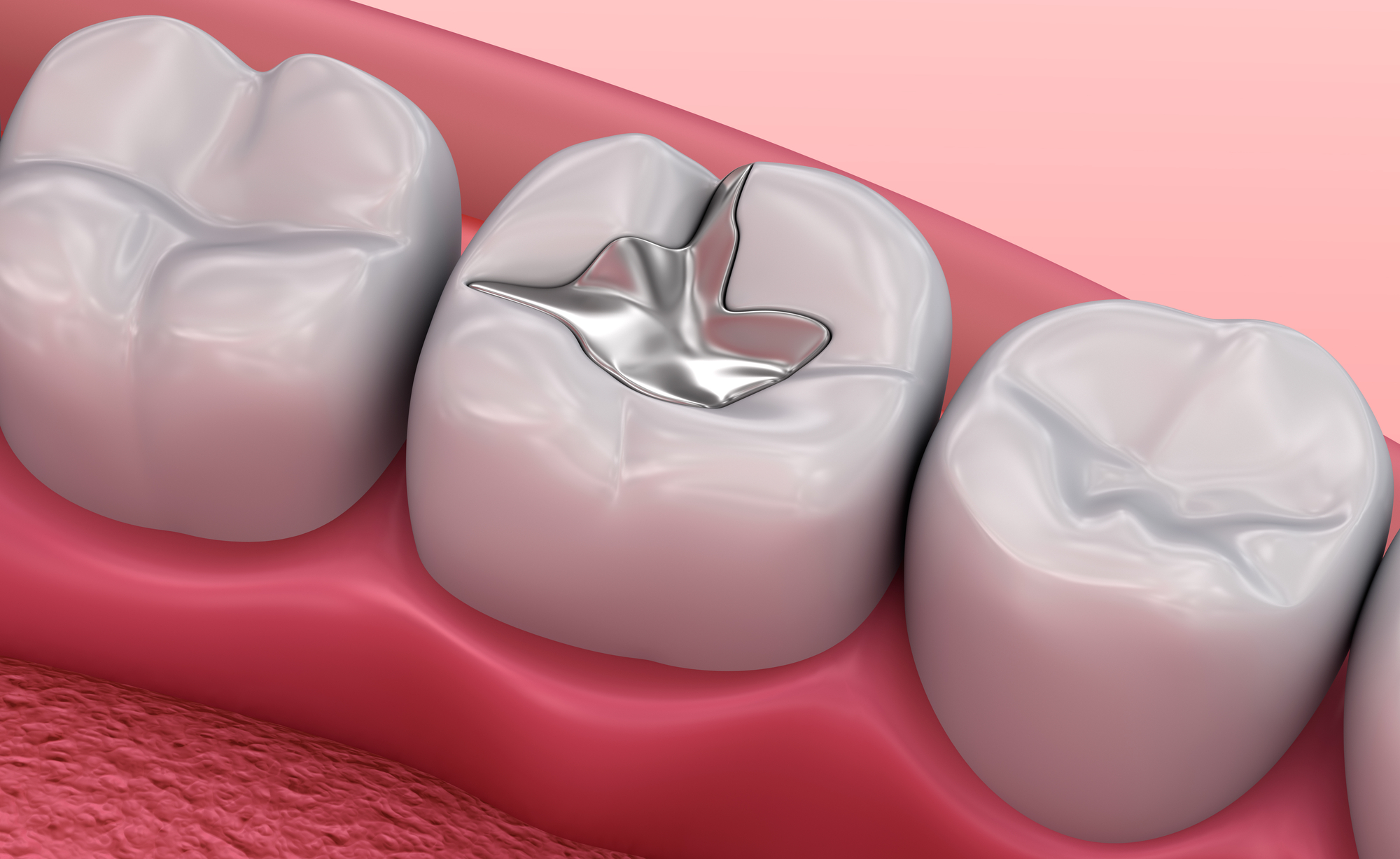 Dental Fillings: 5 Key Ways to Improve Your Smile
