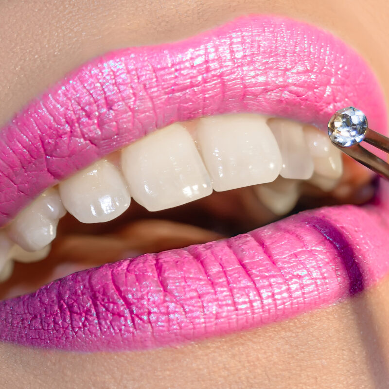 dentist placing tooth gem on woman's tooth