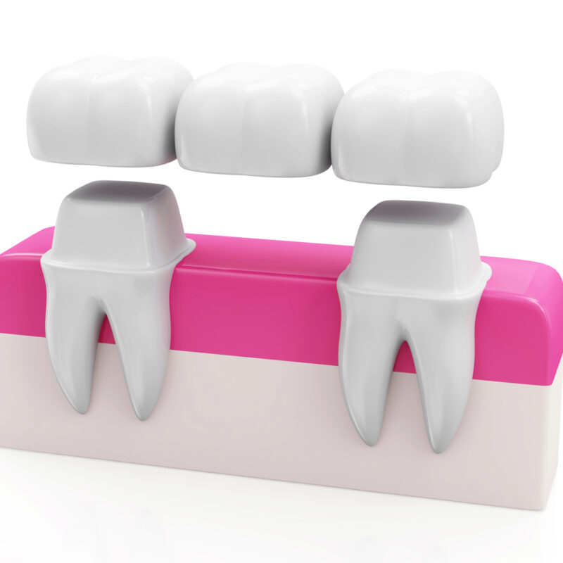dental bridges concept