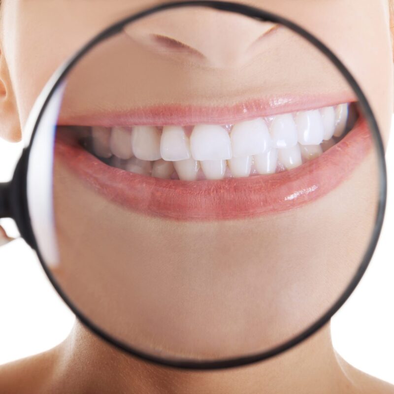 magnifying glass over woman's smile with veneers