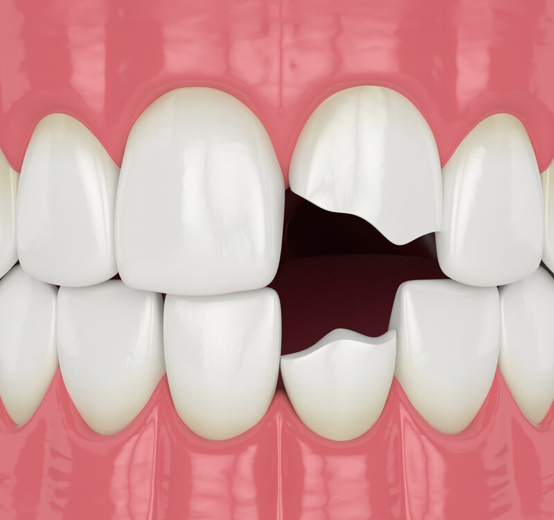 illustration of knocked out tooth a dental emergency