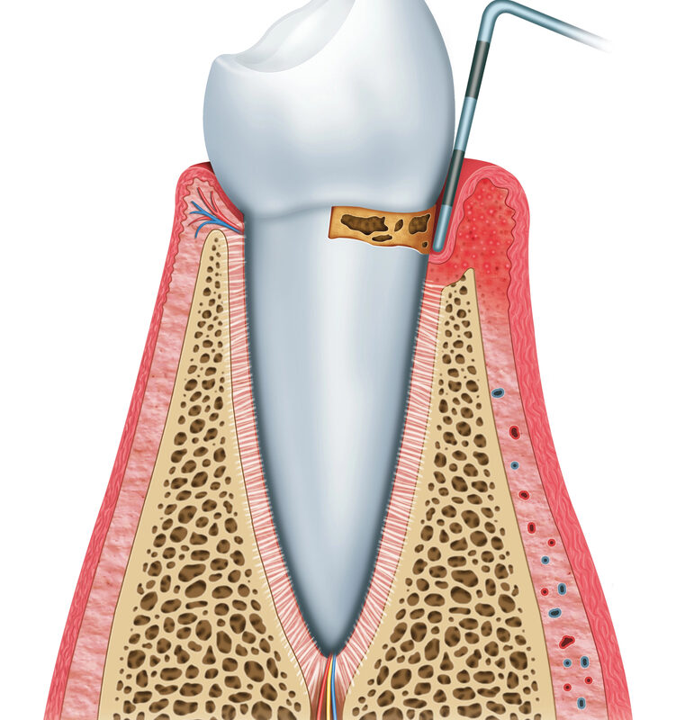 illustration of gum disease and dental cleaning