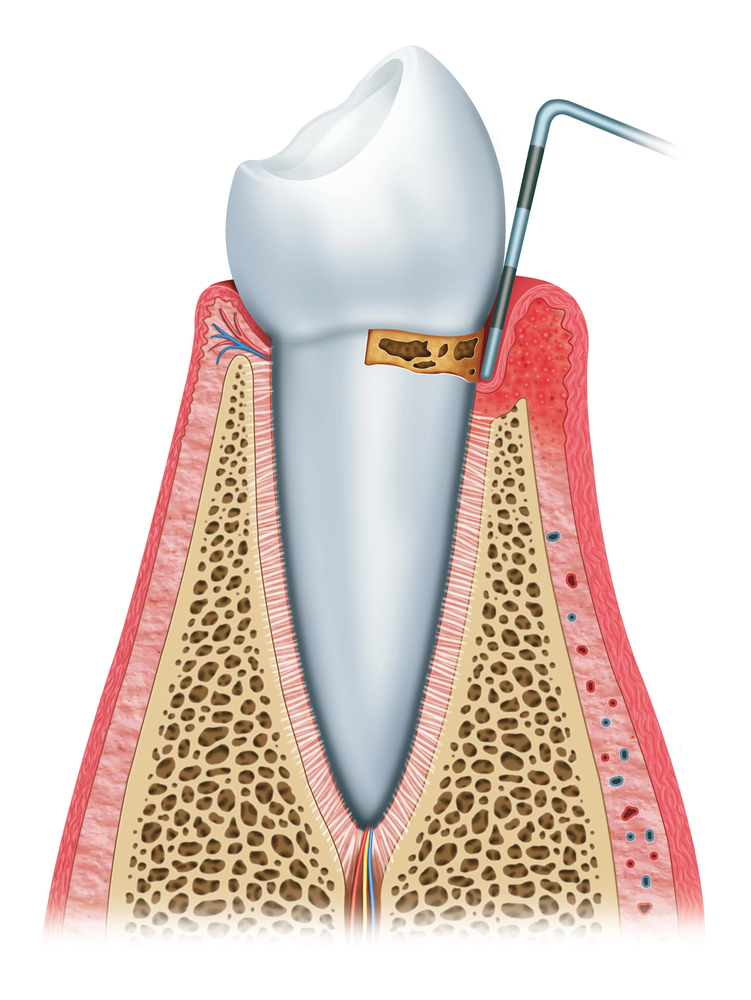 6 Reasons to Attend 6-Month Dental Checkups and Cleanings