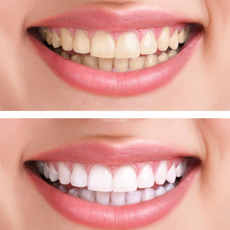 teeth whitening before and after