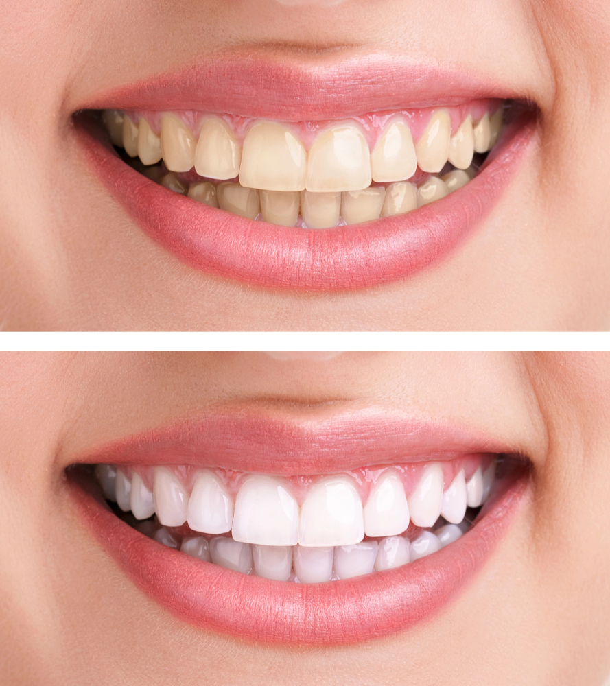 Are you an ideal candidate for teeth whitening? Find out now!