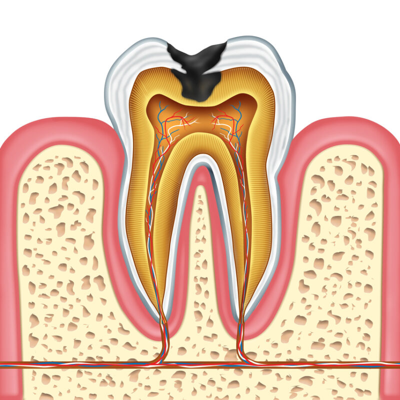 diagram of the inside of a tooth with a cavity