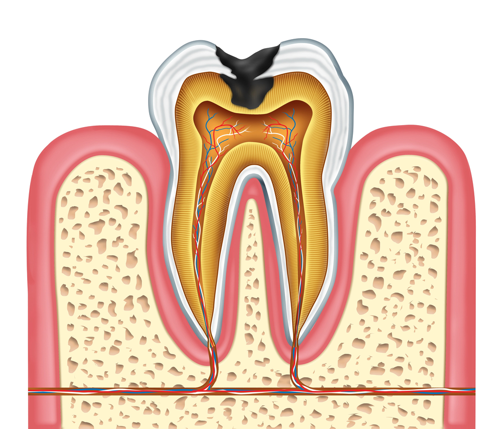 Can Cavities Be Restored Naturally?