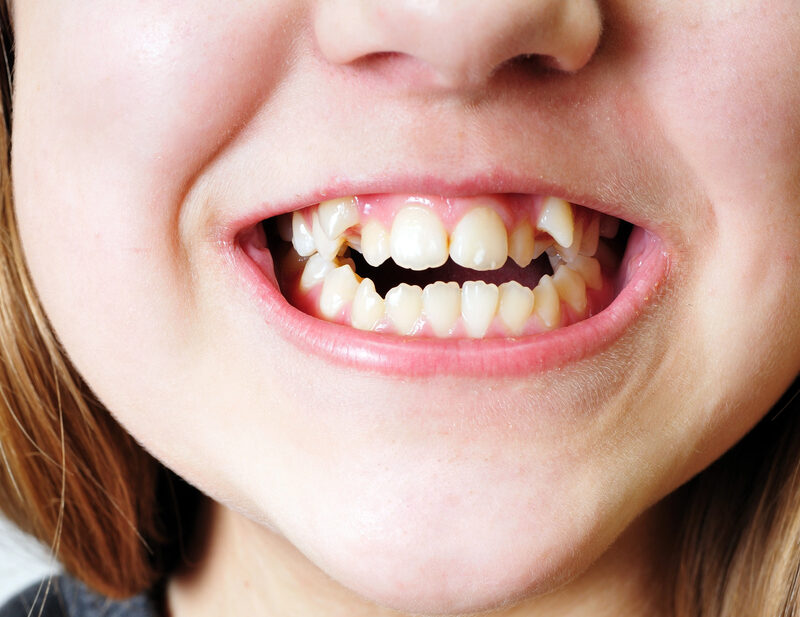 close up of child's smile with crooked teeth