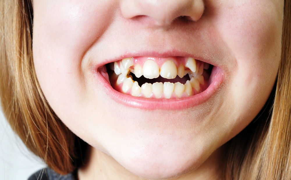 Are Crooked Teeth Genetic?