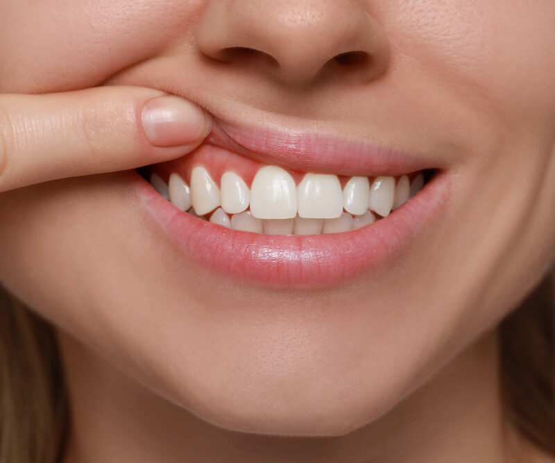 woman pointing to bump on gums