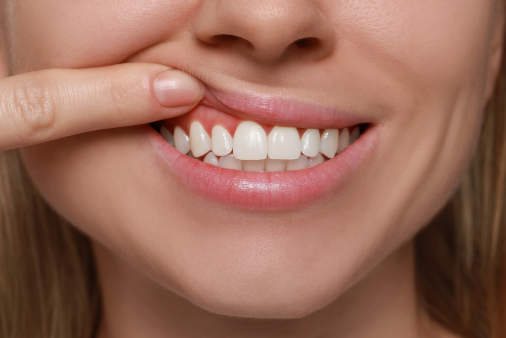 Mission, BC, Dentist Explains Bumps on Gums