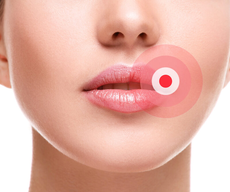 close up of woman's lip with mouth ulcer or Canker sore highlighted