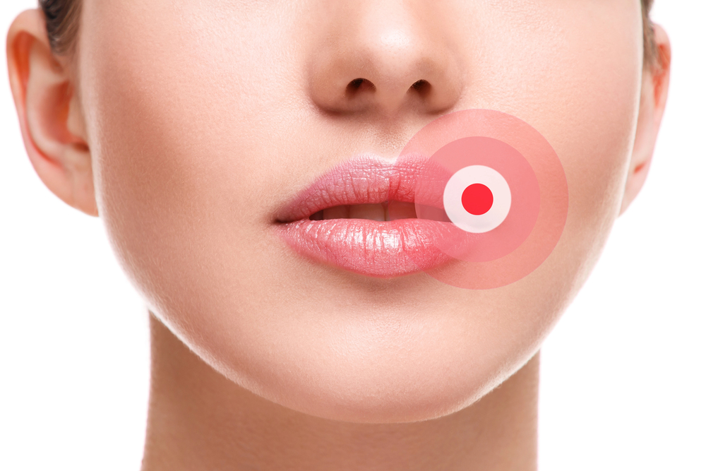 What Can Be Done for Mouth Ulcers or Canker Sores?