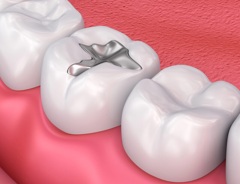 close up of tooth with metal filling