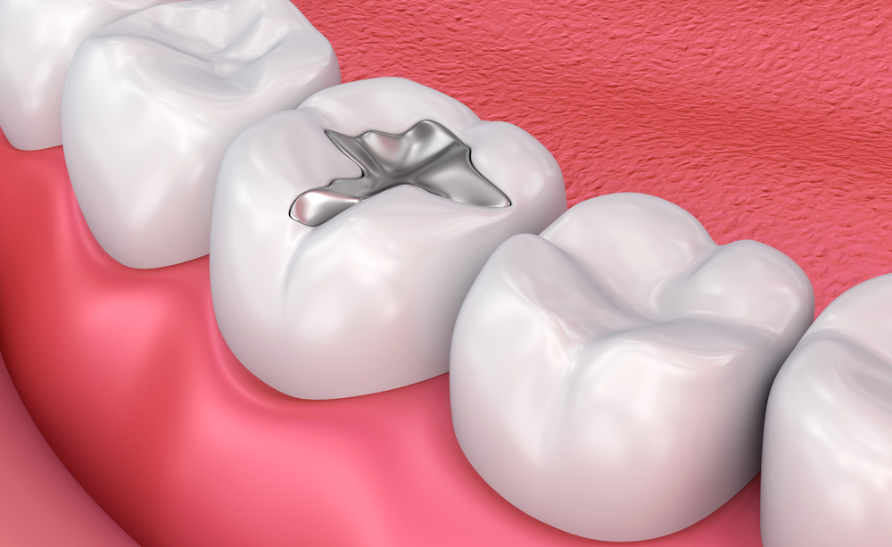 5 Reasons to Fill in Cavities Just in Time for Holiday Eating