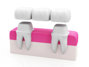 dental bridges for teeth