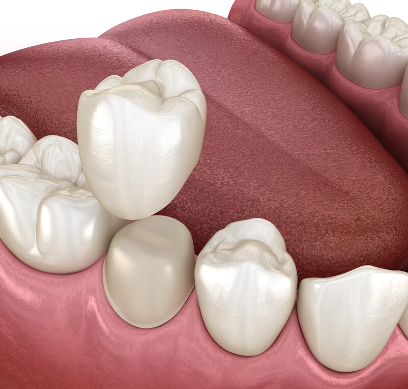 Preparated premolar tooth and dental crown placement. Medically accurate 3D illustration