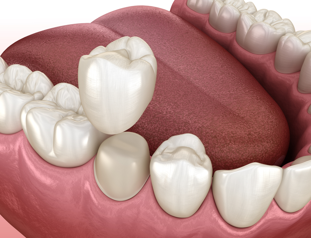 Everything You Need to Know About Crowns for Teeth