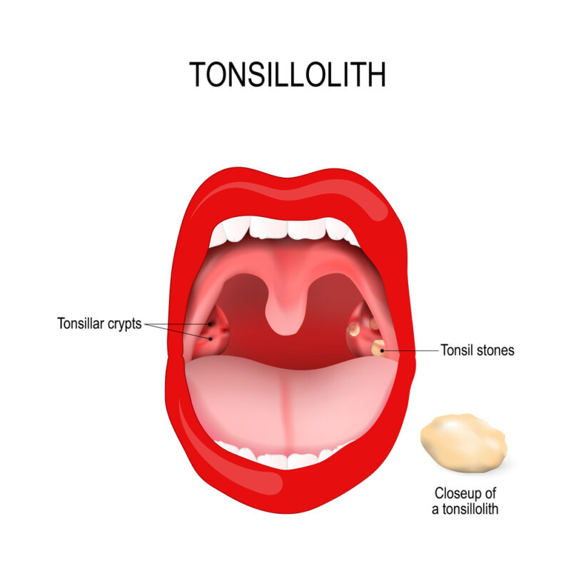 tonsillolith lodged in the tonsillar crypt. close-up of the tonsil stones. Human mouth. Vector diagram for medical and educational use