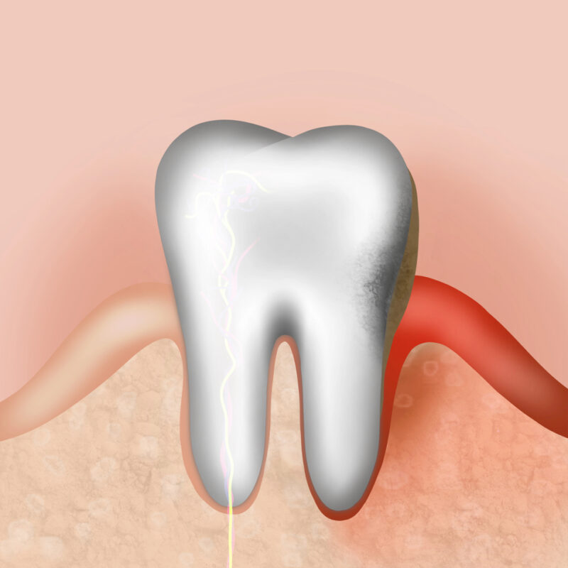 gingivitis bump, bleeding gum illustration
