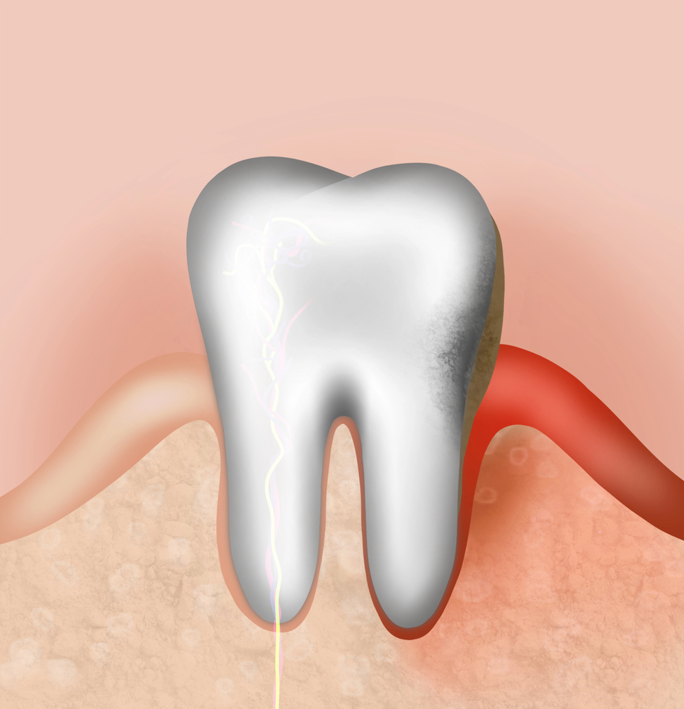 Gingivitis Bumps vs. Other Gum Issues: How to Spot the Difference