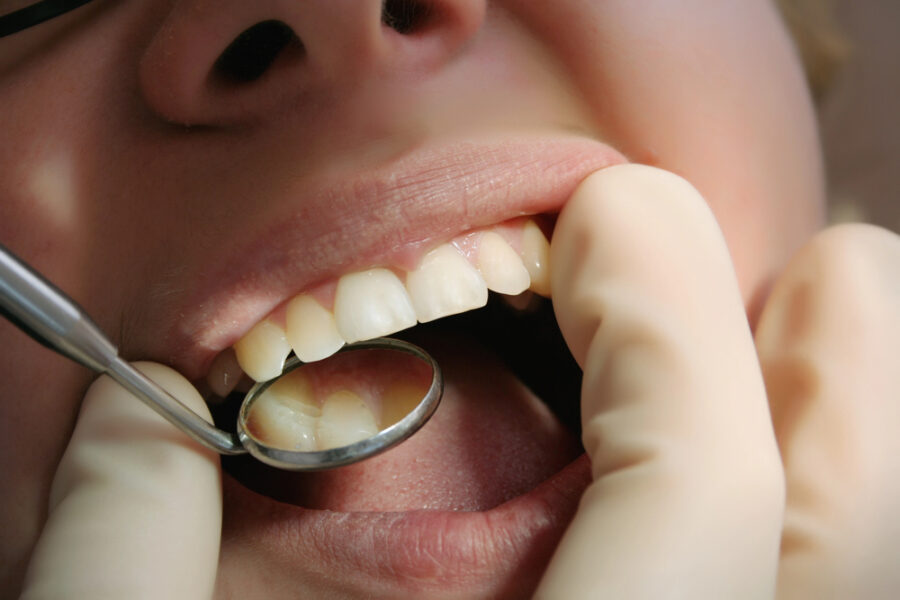 close up of dentist examining patient's mouth with dental mirror