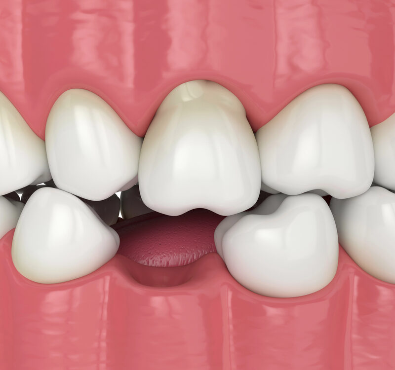 3d render of mouth with a missing bottom tooth