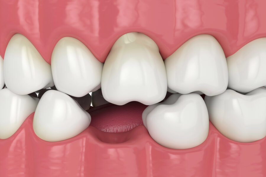 3d render of mouth with a missing bottom tooth