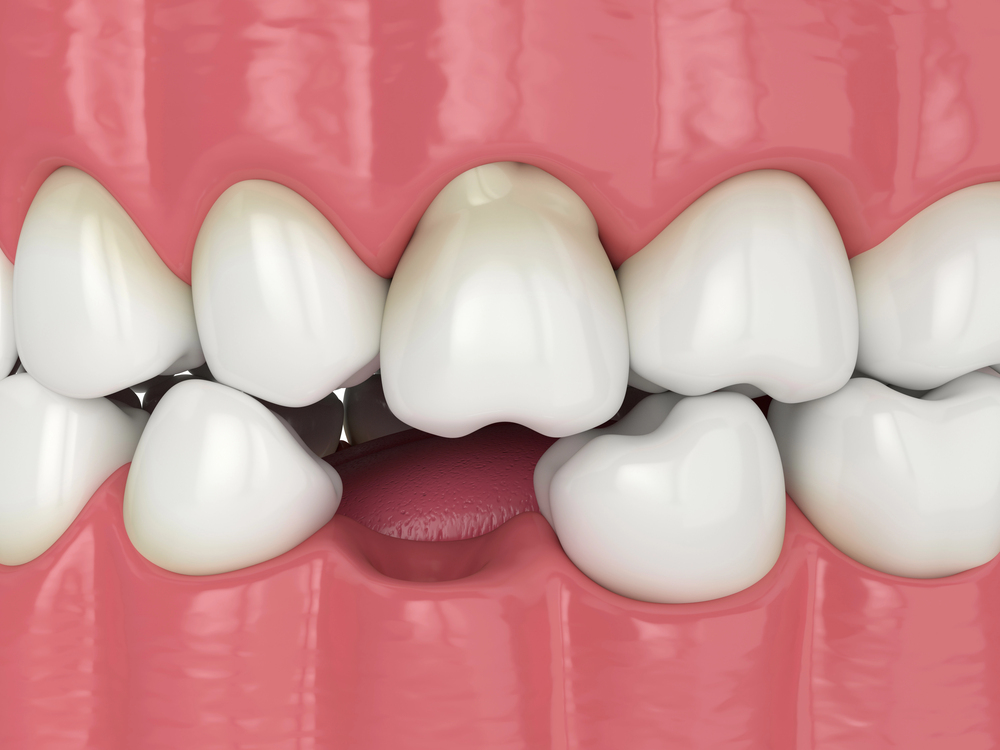 What Are the Options for Replacing a Missing Tooth?