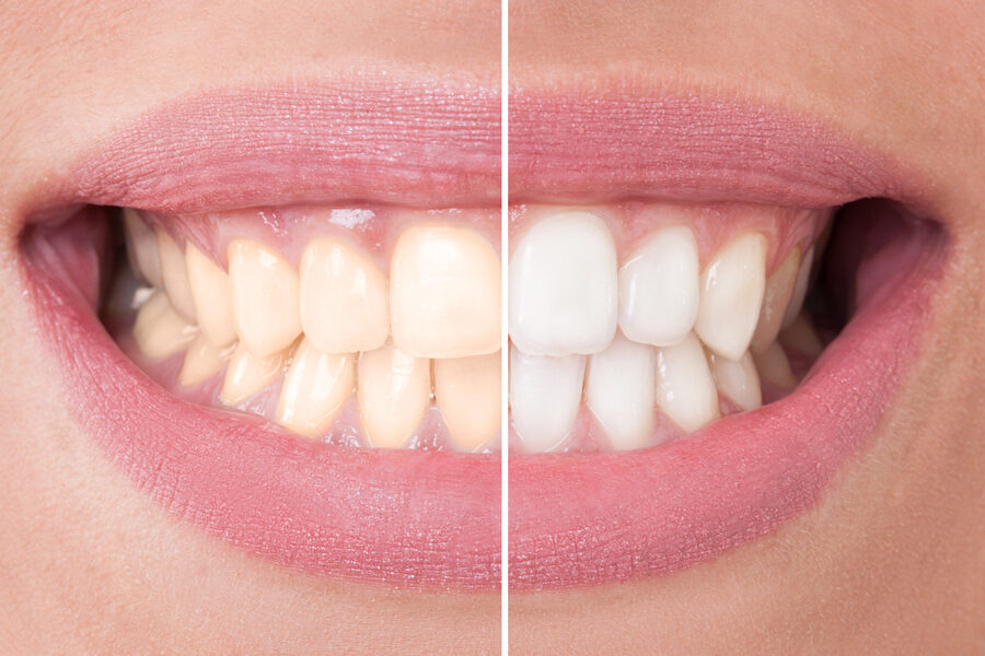 close up of woman's teeth before and after teeth whitening