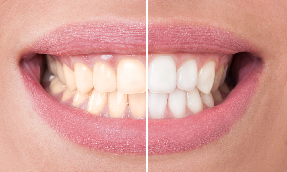 What Are the Benefits of Professional Teeth Whitening Compared to At-Home Kits?