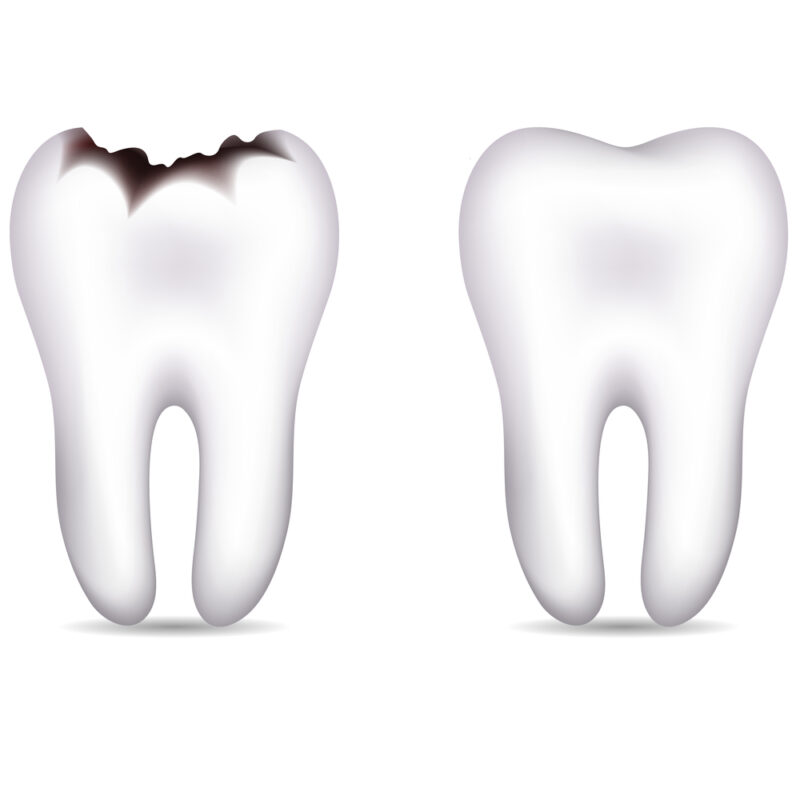 tooth with and without cavities