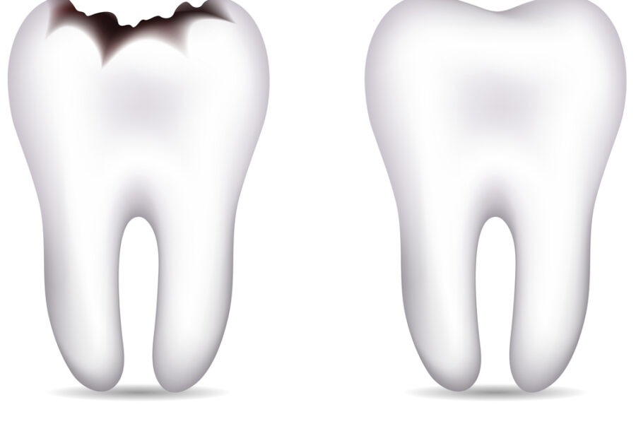 tooth with and without cavities