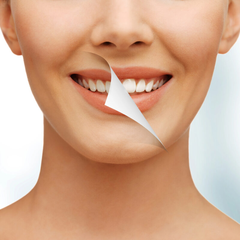 close up of woman's smile before and after cosmetic dentistry treatment