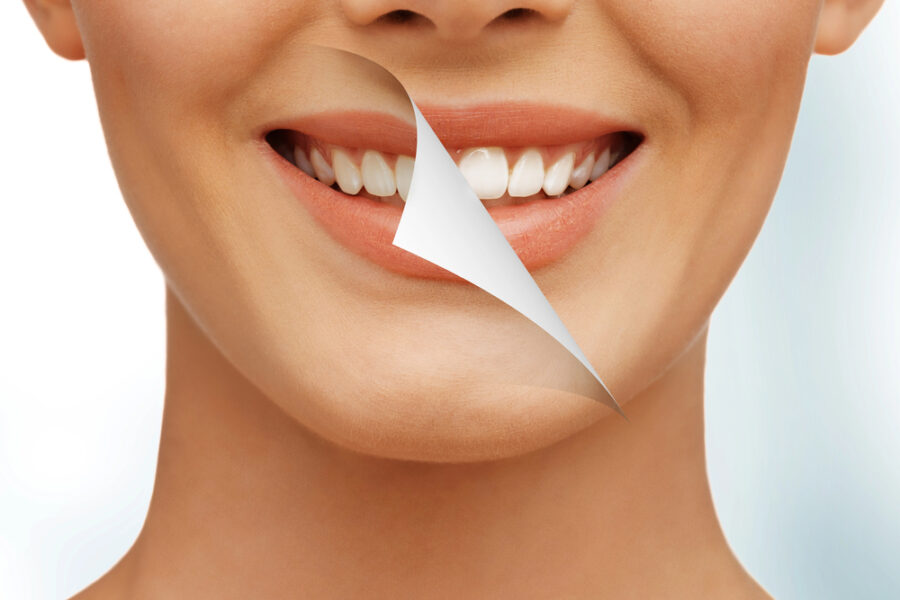 close up of woman's smile before and after cosmetic dentistry treatment
