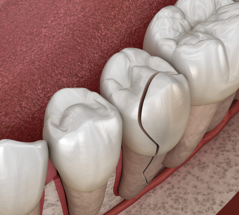 3D illustration of cracked tooth