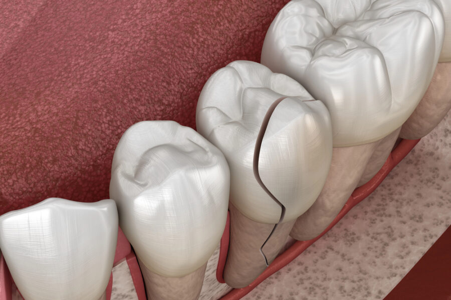 3D illustration of cracked tooth