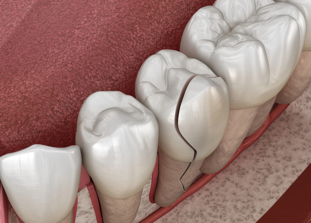 Cracked Tooth in Accident: What to Do in the First 24 Hours