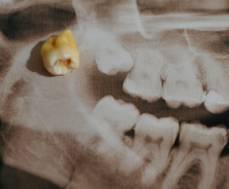real tooth sitting on dental x-ray